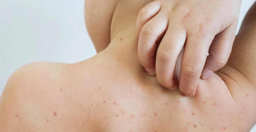 Alerta epidemiológica por nuevos casos de sarampión en&nbsp;Argentina